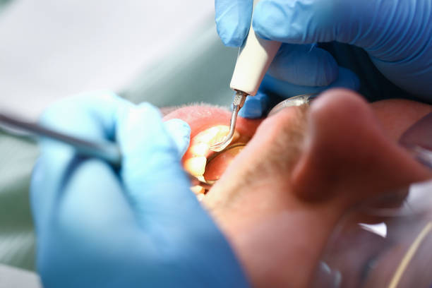 Best Emergency Dental Care for Broken or Chipped Teeth in Graham, WA