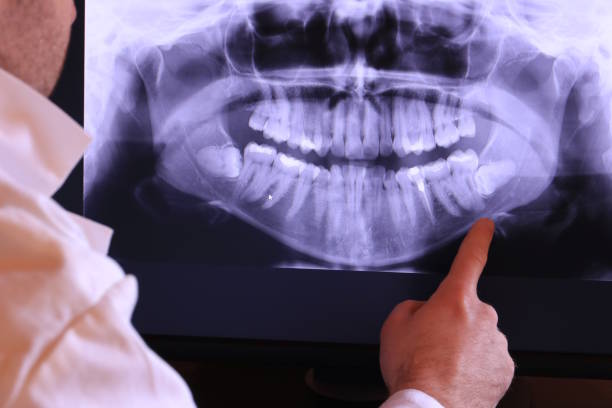 Best Emergency Tooth Extraction in Graham, WA