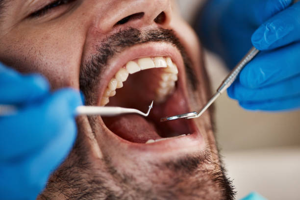 Best Emergency Wisdom Teeth Removal in Graham, WA