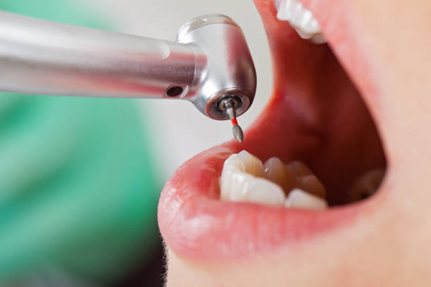Best Emergency Wisdom Teeth Removal in Graham, WA